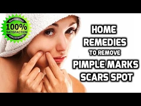 how-to-remove-pimples-fast-at-home-||-8-quick-home-remedies-to-remove-acne-overnight
