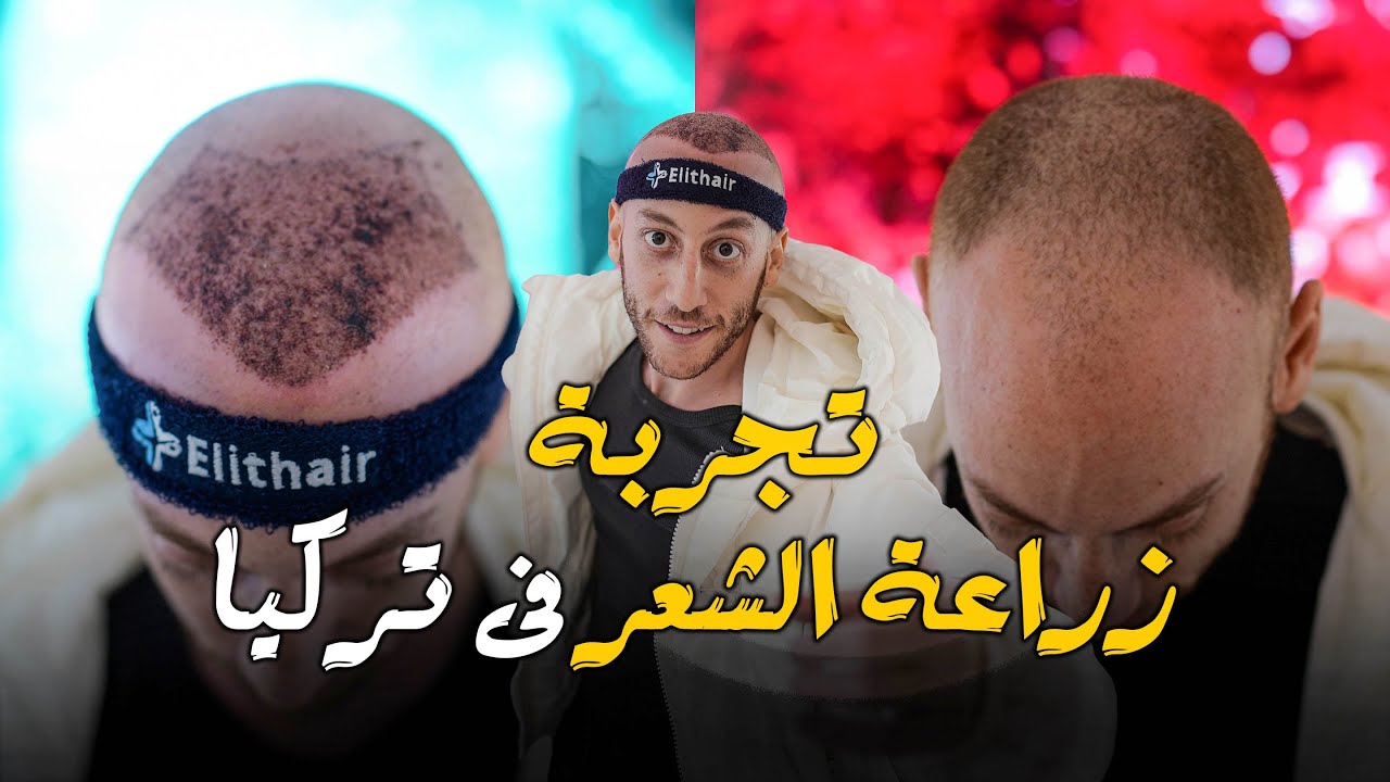 تجربة زراعة الشعر فى اكبر مسشتفى لزراعة الشعر فى العالم! 🇹🇷- Turkey