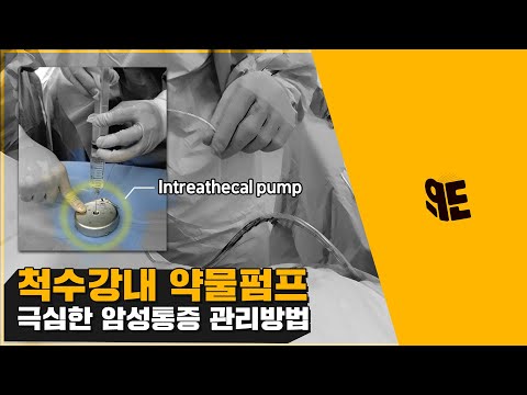 통증중재치료의 최신 트렌드를 알아보자 │척수강내 약물주입펌프(上)