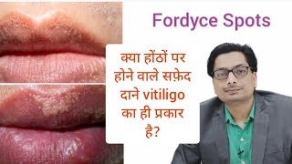 Fordyce Spots | क्या होंठों पर होने वाले सफ़ेद दाने vitiligo का ही प्रकार है? #vitiligo #Leucoderma