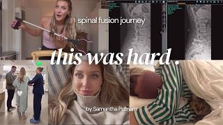 What I wish I knew before my Spinal Fusion | 3 month update and journey 🤍