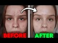 I Cleared My Sister's Skin... After YEARS Of Acne