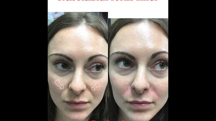 Nasolabial folds filler - DayDayNews