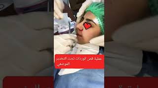 عملية تجميل الانف موضعيا local anesthesia alarplasty