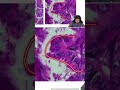 HOBNAIL PTC - 08 #neetpg #neetss2026 #pathology