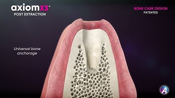 EN Video 3D Axiom X3® BONE IS GOLD - Post Extraction