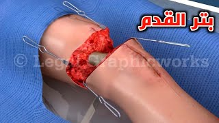 شاهد كيف تكون عملية بتر القدم في الحقيقة_Leg and foot amputation