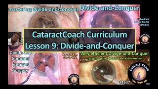 CataractCoach 1637: curriculum lesson 9: divide and conquer