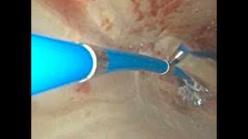 aScope 5 Broncho HD: Endobronchial Dilation