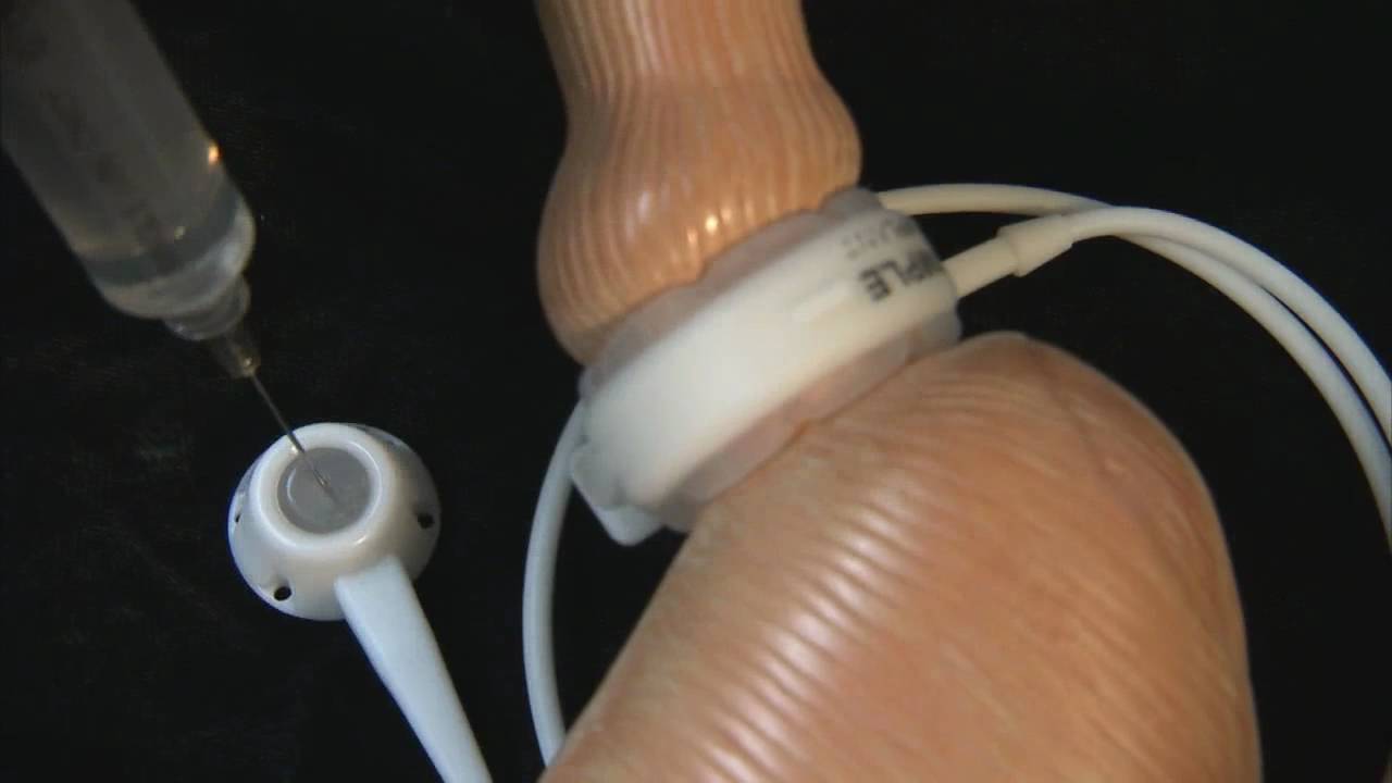 Adjustable Gastric Bands Explained YouTube