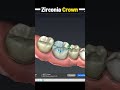 Zirconia Crown Procedure Explained : Pros and Cons in 1 minute