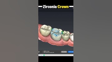 Zirconia Crown Procedure Explained : Pros and Cons in 1 minute