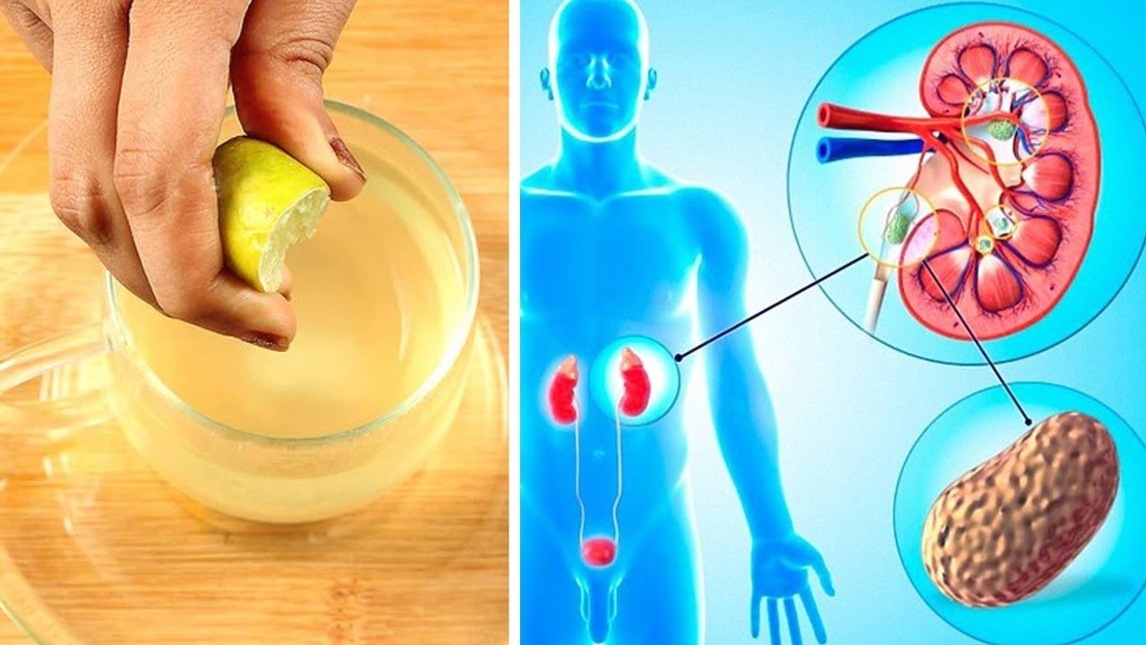 Natural Home Remedies For Kidney Stones YouTube
