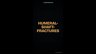 Humeral Shaft Fracture Alignment: Acceptable Limits Explained