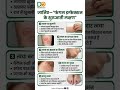 "फंगल इन्फेक्शन के शुरुआती लक्षण जो आप नजरअंदाज कर देते हैं!#fungal #infection #skindiseases #skin