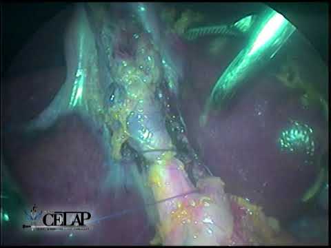 coledocolitiasis residual post ERCP, resuelta por laparoscopía video phone lyrics