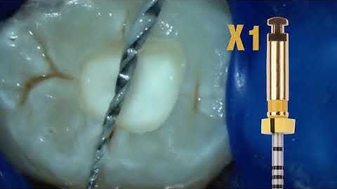 Dentsply ProTaper Next Rotory Files - DENTBEAR