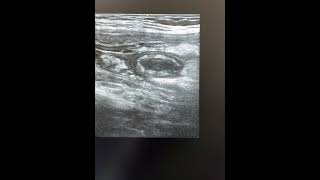 Acute Appendicitis #ultrasonography #acutepancreatitis