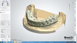 CAD/CAM Tools Tips & Tricks BruxZir FullArch Implant Prosthesis Design (Vol. 1, Issue 3)