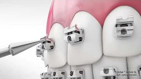 Mắc cài 3M Unitek Gemini Self Ligating System