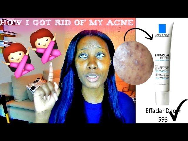 Best How To Get Rid Of Acne Tutorial | Dydy xoxo class=