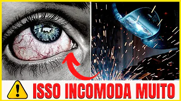 O que é bom para queimadura de solda nos olhos?