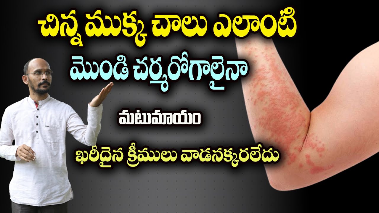 చిన్న ముక్క చాలు...ఎలాంటి మొండి చర్మరోగాలైనా  మటుమాయంఖరీదైన క్రీములు వాడనక్కరలేదు