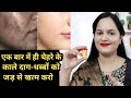 चेहरे के काले दाग-धब्बे झाइयां,निशान दूर करने की सबसे तेज Cream |Dark Spots on face removal