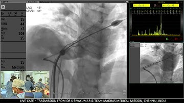 6/10 Percutaneous Pulmonary valve implantation (PPVI ) with Venus P valve in native RVOT
