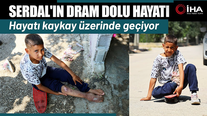 Kaza Sonrası Ayağı Yanlış Kaynadı Hayatı Kaykay Üzerinde Geçiyor