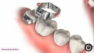 Appliance- Seperator