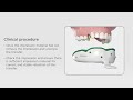 Ev prosthetics  impression technique with closed tray