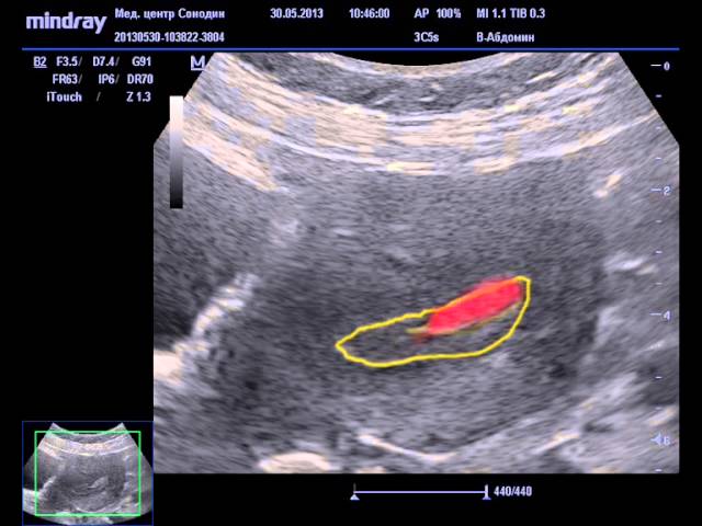 Эндометрий видео. Васкуляризация полипа эндометрия. Аденоматозные полипы эндометрия.