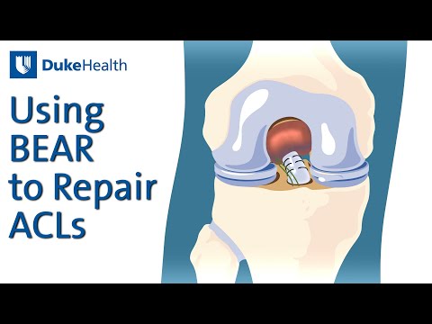 Using the BEAR Procedure for ACL Repairs | Duke Health