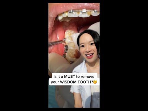 Video: Ar turėčiau pašalinti pažeistus protinius dantis?