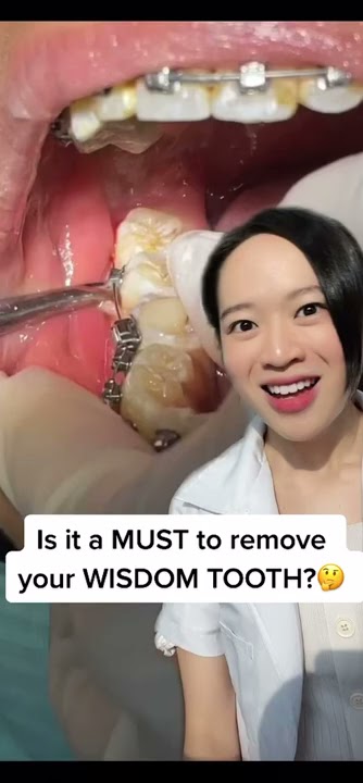 MUST you extract your Wisdom Tooth? ðĪ Here's the answer! ðĪððĶ· #shorts