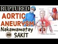 Ruptured Aortic Aneurysm: Nakamamatay na Sakit – by Doc Willie Ong #1038