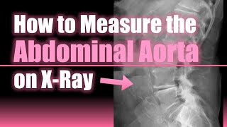 How to Measure the Abdominal Aorta on X Ray 📏🫀🩻#howto #medical #doctor