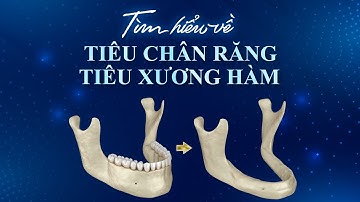 Cách khắc phục Tiêu Xương trong răng hàm mặt