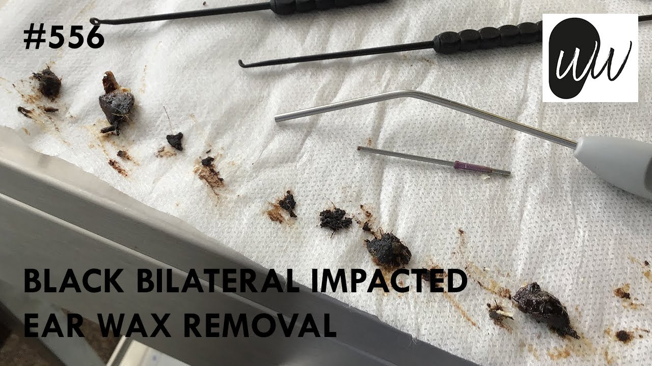 556 - Black Bilateral Impacted Ear Wax Removal - YouTube