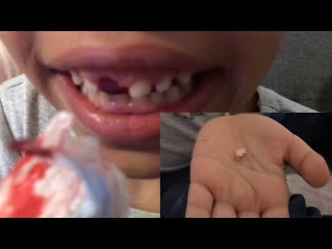 Vidéo: Comment Arracher Une Dent Chez Les Enfants Et Vous-même