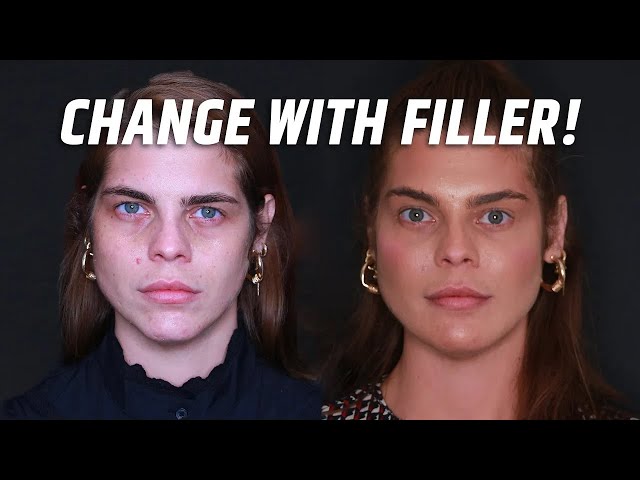 FULL FACE FILLER TRANSFORMATION | Dramatic Before & After Getting Dermal Filler Treatment