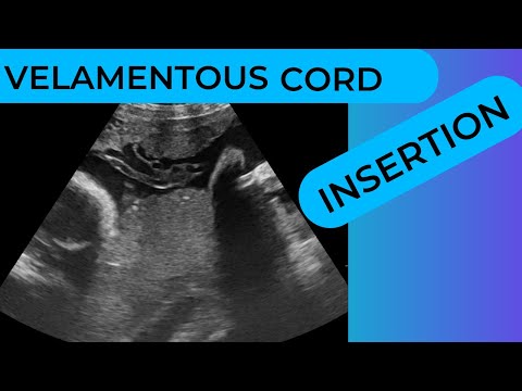 Video: Puas yog Velamentous cord insertion txaus ntshai?