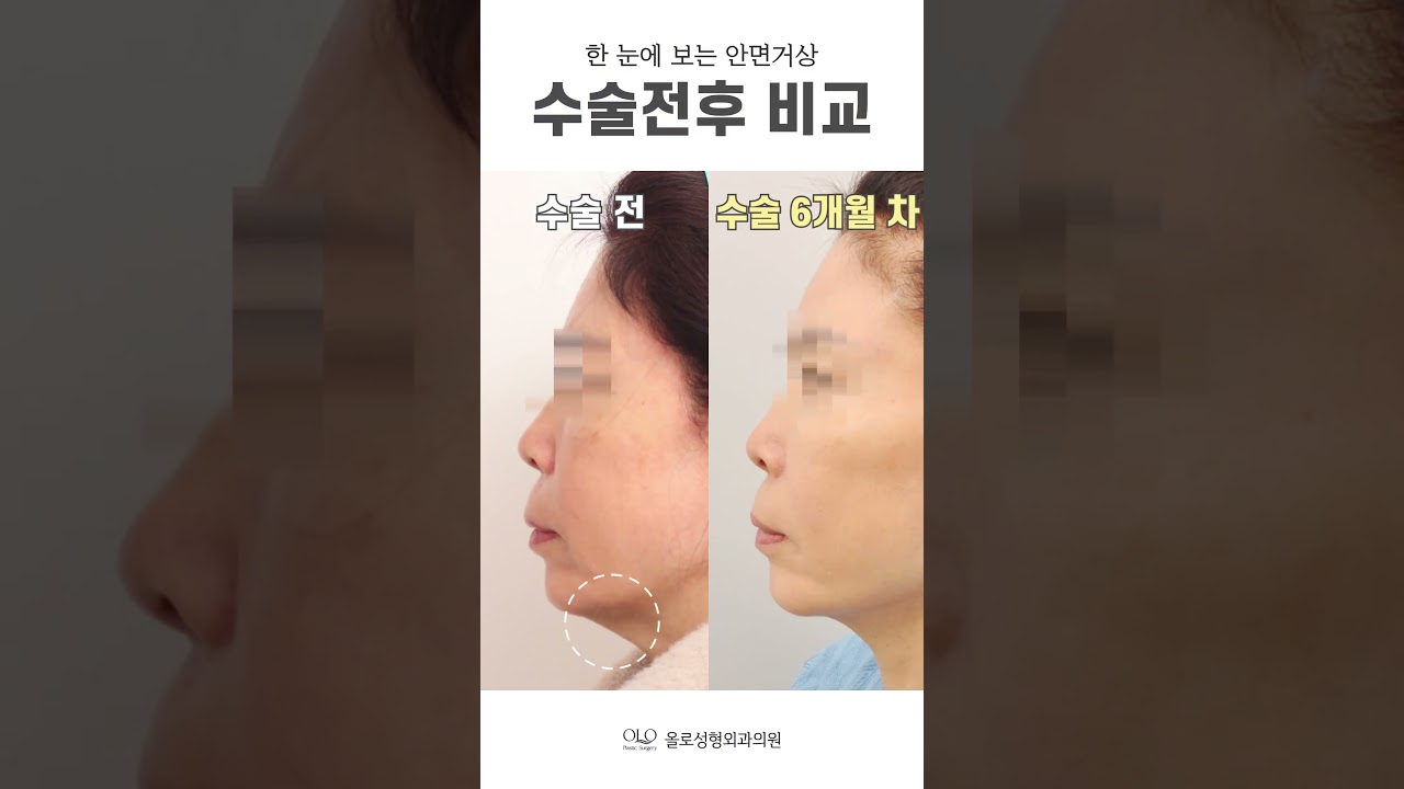 [奧羅整形外科診所] #改善皺紋 #面部拉提 唯有在奧羅才能重現的 #下顎線 消失的 #頸紋 #短片