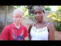 AFRİKADAKI ALBINO ÇOCUKLAR BÜYÜK TEHLİKEDE -Mozambik