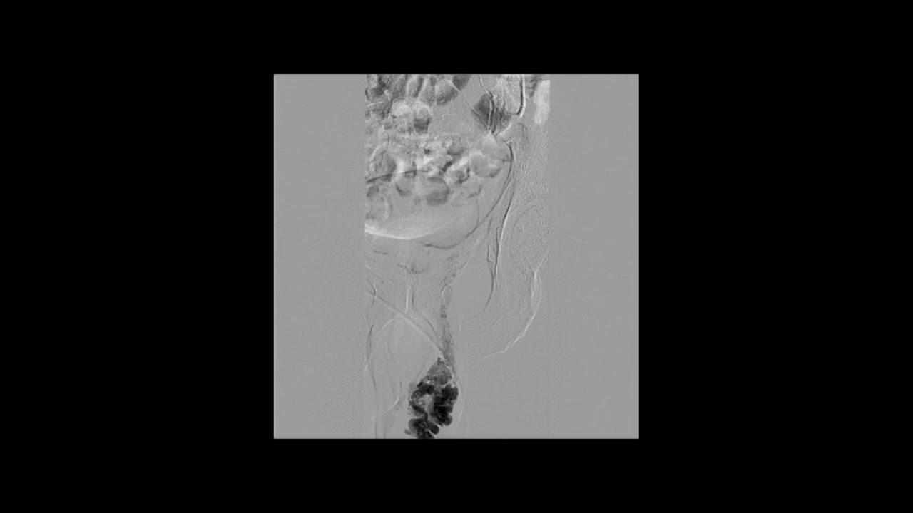 Лечение варикоцеле без разрезов методом эмболизации - YouTube