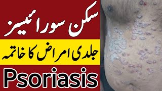 Psoriasis Treatment | Skin Allergy ka ilaj | Psoriasis Scalp Removal Treatment | Hakeem Zia Shahid