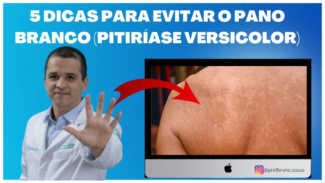 Cinco dicas para prevenir o pano branco pitiríase versicolor. YouTube