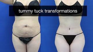 Tummy Tuck Beverly Hills Baby Bump Gone With Dr. Dass