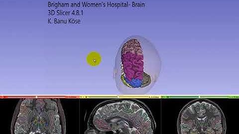 3D Slicer 4.8.1 / Brain
